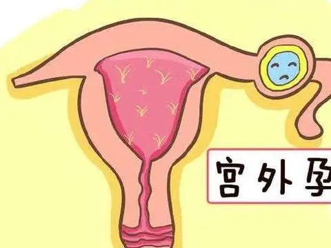 东莞长安宫颈糜烂面积大会影响宫外孕吗?